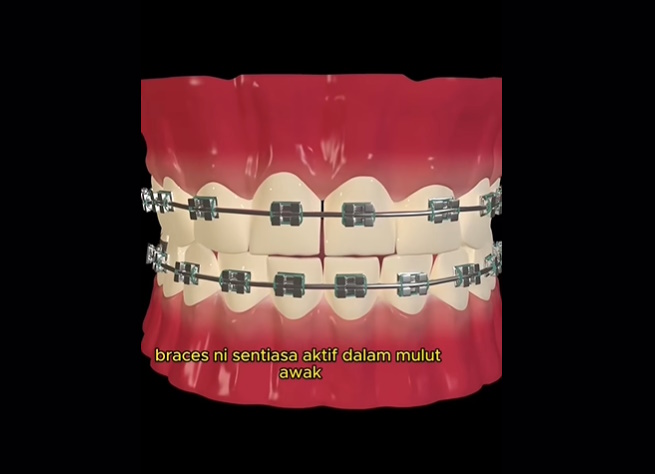 视频|牙套不是时尚配件! 牙医警告:长期戴恐损害牙齿