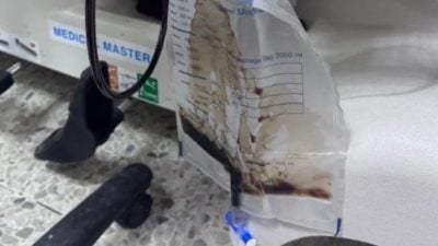 迟交作业被罚深蹲200次 中学生横纹肌溶解 尿液变黑！