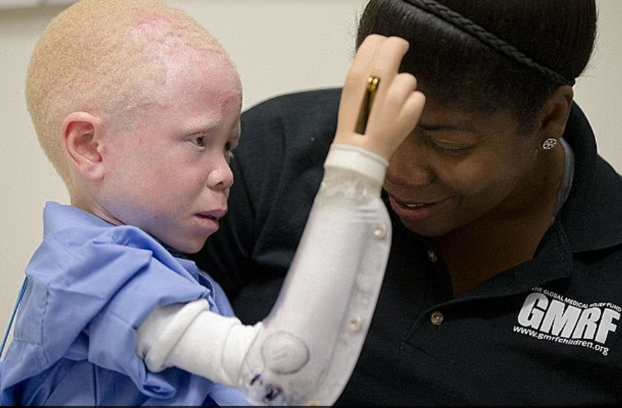 非洲白化病男童遭父亲斩下手臂 高价卖给巫医“制作幸运灵药”