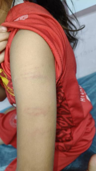 （大北马）2名5岁女童疑在网球训练中多次未能掌握动作被老师鞭打留下鞭痕