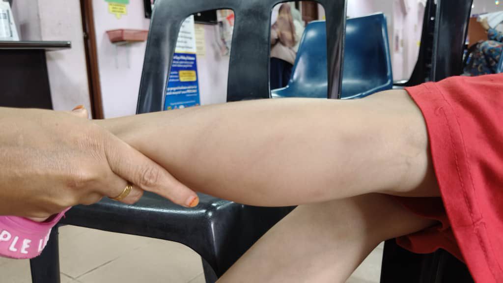 （大北马）2名5岁女童疑在网球训练中多次未能掌握动作被老师鞭打留下鞭痕