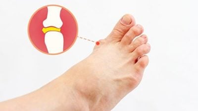 管理痛风，这5个关键点你考虑到了吗？