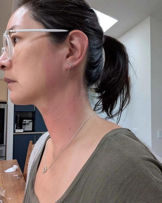 Janet高烧40度脖子大片红肿 医生无解上网求助