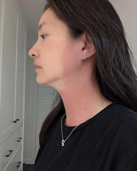 Janet高烧40度脖子大片红肿 医生无解上网求助