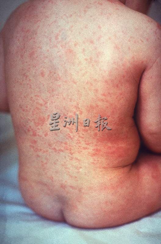 供星洲网:麻疹风疹病例现回升,周世扬呼吁响应接种疫苗计划