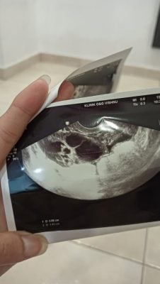 女子长期未做子宫检查 月经异常就医 惊觉5公分水瘤