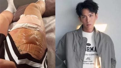 柯震东右腿严重烫伤 2巨大水泡怵目惊心！