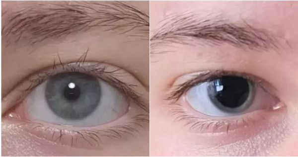 女子上网分享眼睛照　网友警告立刻就医救一命