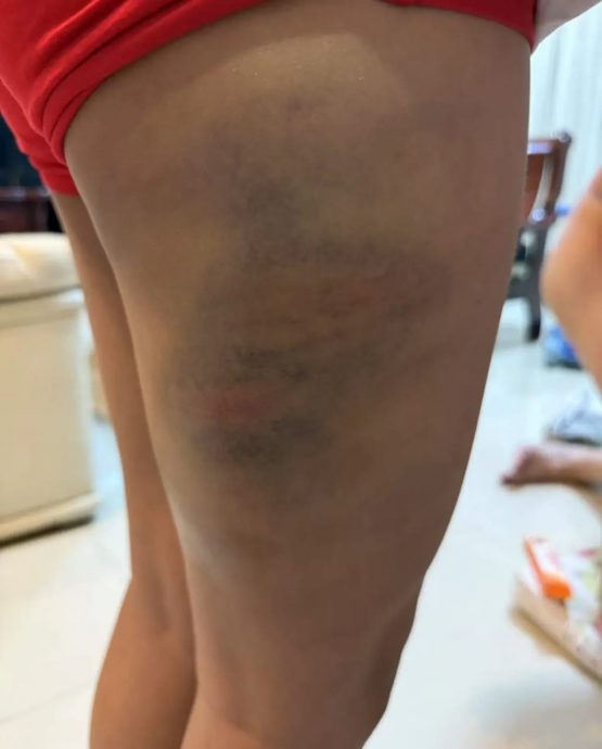 9岁男童遭舅舅藤条鞭打 大腿满布瘀青红肿 警方追捕31岁男子