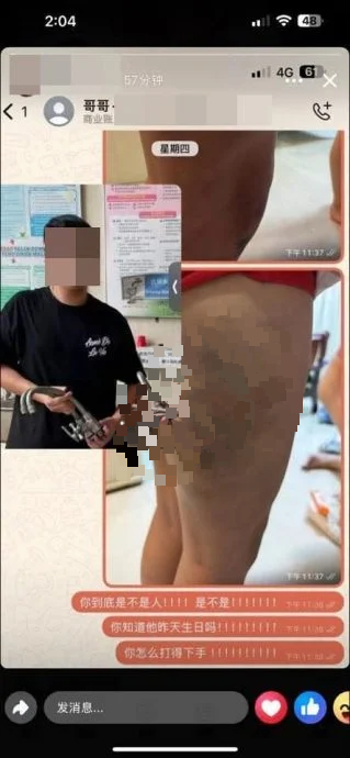 9岁男童遭舅舅藤条鞭打 大腿满布瘀青红肿 警方追捕31岁男子