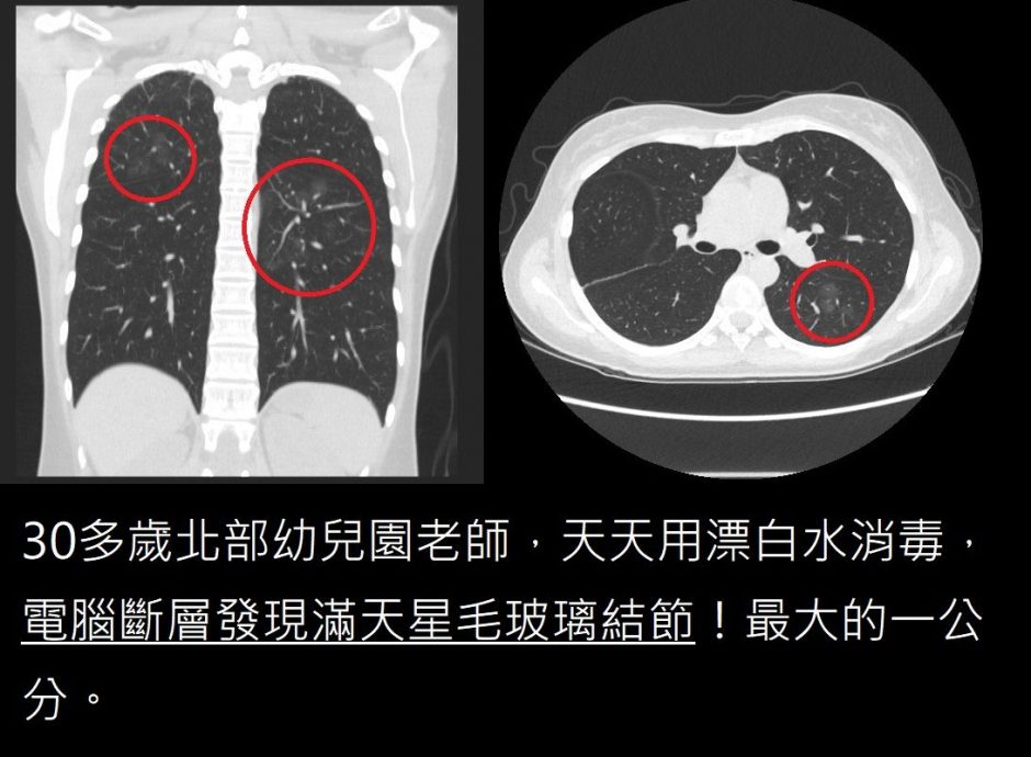 幼儿园老师从不抽烟 肺部满布肺结节 竟是漂白水害的