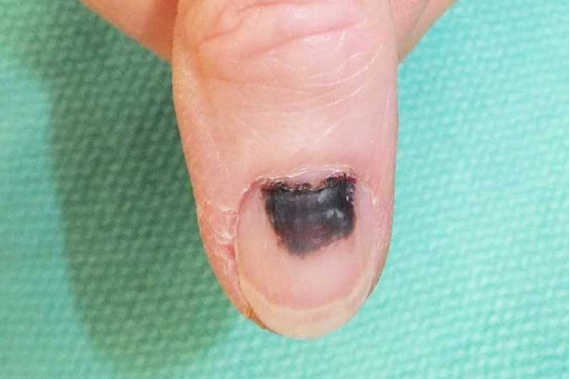 指甲出现深色竖线恐是警讯! 专家警告:恐是皮肤癌前兆