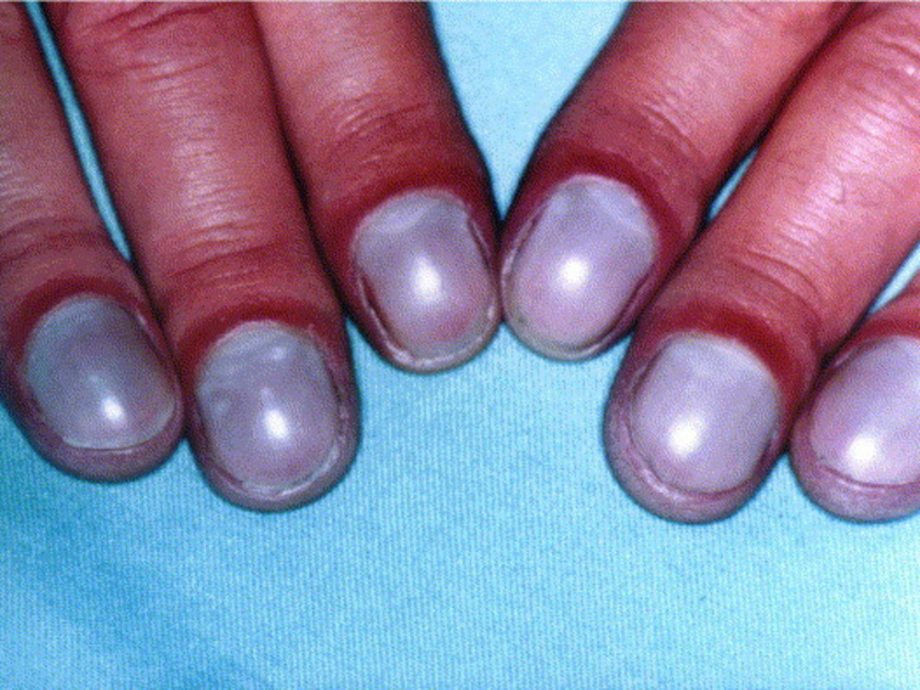 指甲有这5种变化?当心健康拉警报!