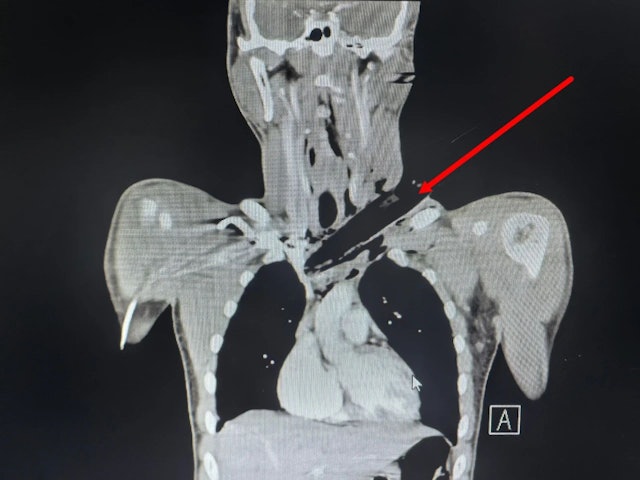 枯树枝跌落竟插入男子颈部直达胸腔　医生：万幸避过所有大血管