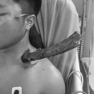枯树枝跌落竟插入男子颈部直达胸腔　医生：万幸避过所有大血管