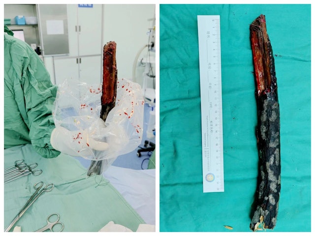 枯树枝跌落竟插入男子颈部直达胸腔　医生：万幸避过所有大血管