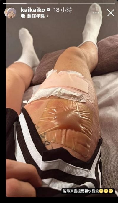 柯震东右腿严重烫伤 2巨大水泡怵目惊心！