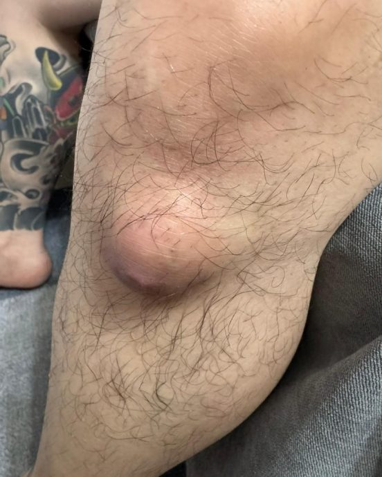 沈宗贤离马留港发展 自爆膝盖长瘤秒速变大