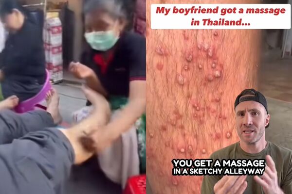 泰国路边按摩意外感染“腿爆脓疮”