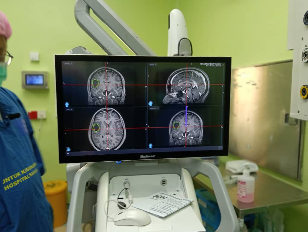 登州医院创历史 33岁病人清醒下开颅切脑瘤 