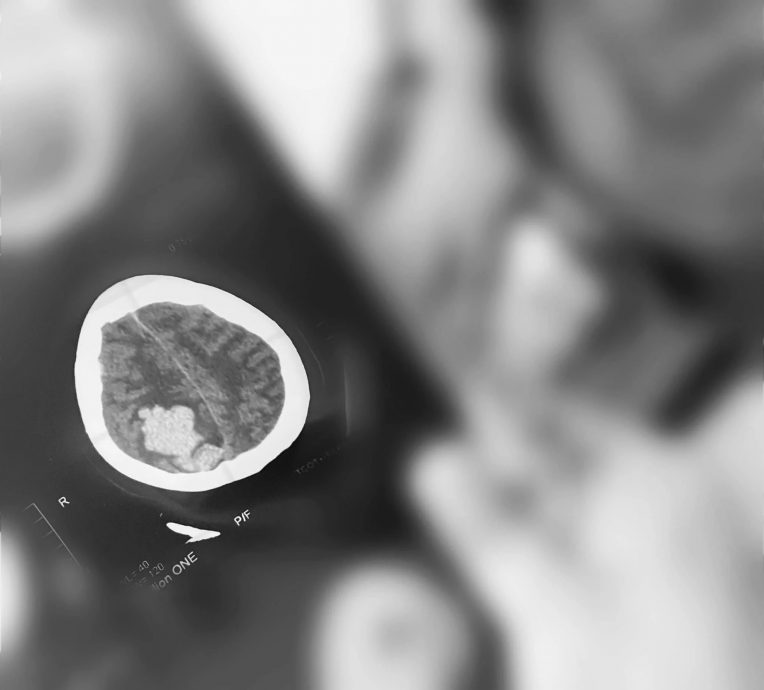 突然倒下就走了 脑溢血愈发年轻要注意!