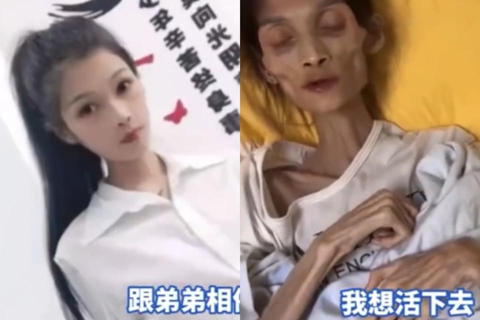 罹患胃萎缩！27岁正妹“45公斤变17公斤”暴瘦成骷髅精