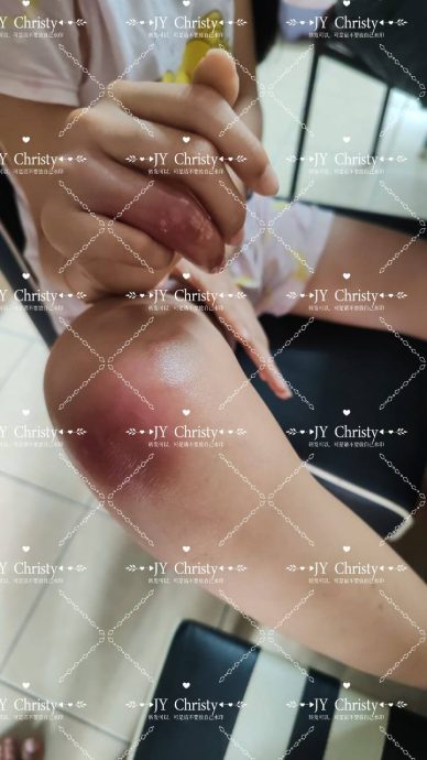 被国旗扣章割伤引发细菌感染 12岁女童动手术保住手指