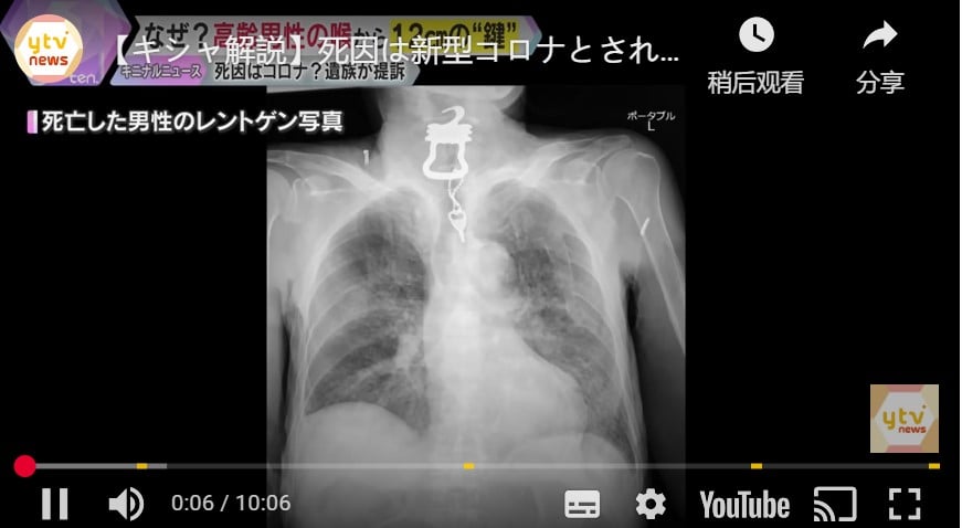 视频| 日82岁翁“喉咙痛”确诊冠病亡 X光竟发现钥匙卡喉咙