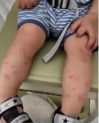 迷信转病邪说强吻男童 华妇害人感染水痘