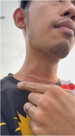 险被割喉 甲洞公园风筝线划伤骑士脖颈