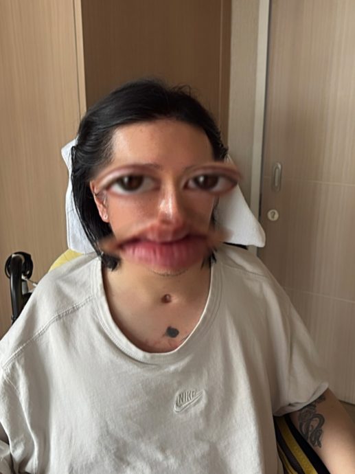 MIRROR演唱会坠屏意外|阿Mo首公开术后正面照 颈部现插喉伤口