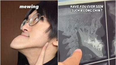 YTR拥世界最长下巴！X光照揭“骨骼惊人真相” 医生也看傻