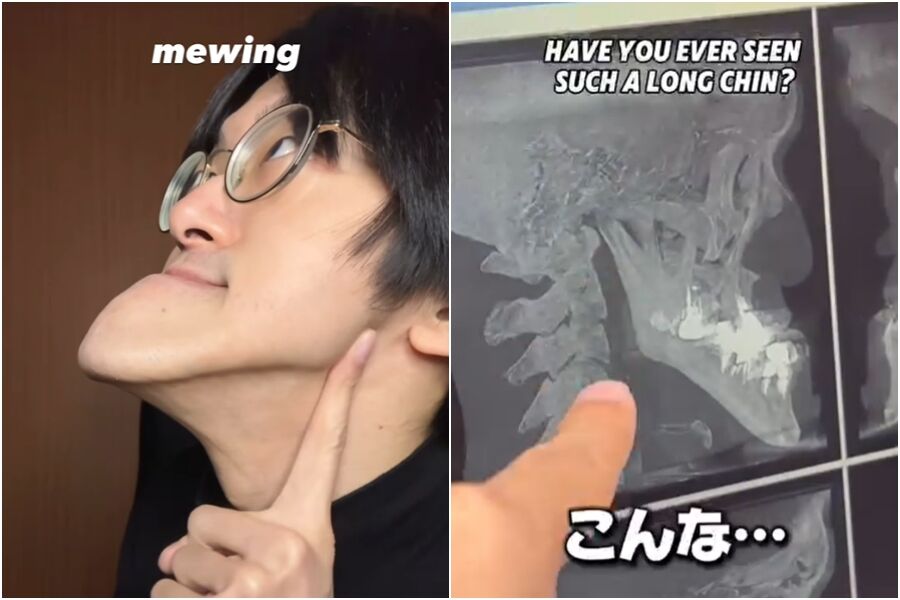 YTR拥世界最长下巴！X光照揭“骨骼惊人真相”　医生也看傻