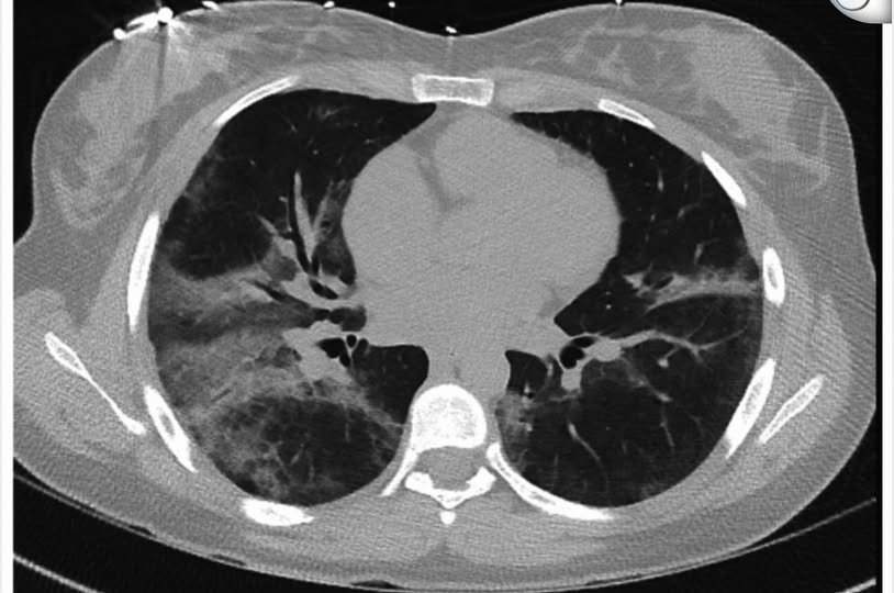 18岁少女迷电子烟两度命危