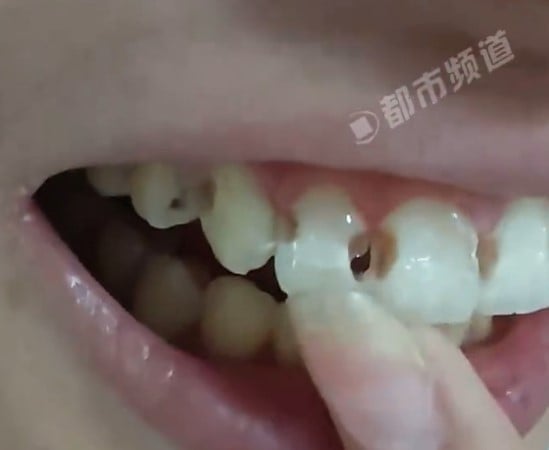 5年牙套竟换来8颗蛀牙！医生一听她的刷牙方式直摇头