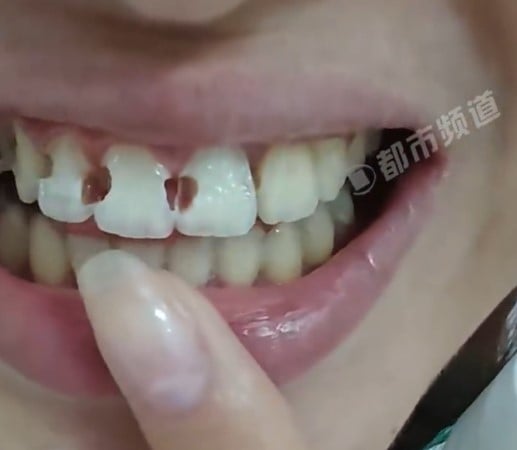 5年牙套竟换来8颗蛀牙！医生一听她的刷牙方式直摇头