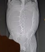 “青蛙肚”藏20公斤宿便 男子手术台上排便如山洪