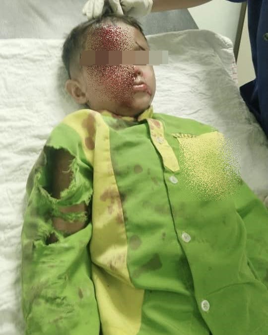 东:已签发:摩托车撞上一只忽然冲出马路的流浪狗,导致骑士和他5岁的儿子受伤。