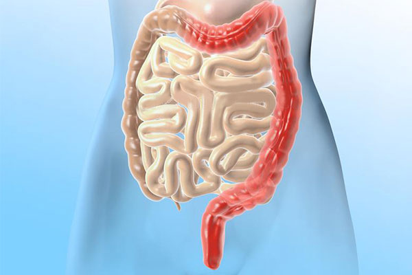 从确诊到开刀仅7天！ 他亲揭被结肠炎盯上切掉大肠