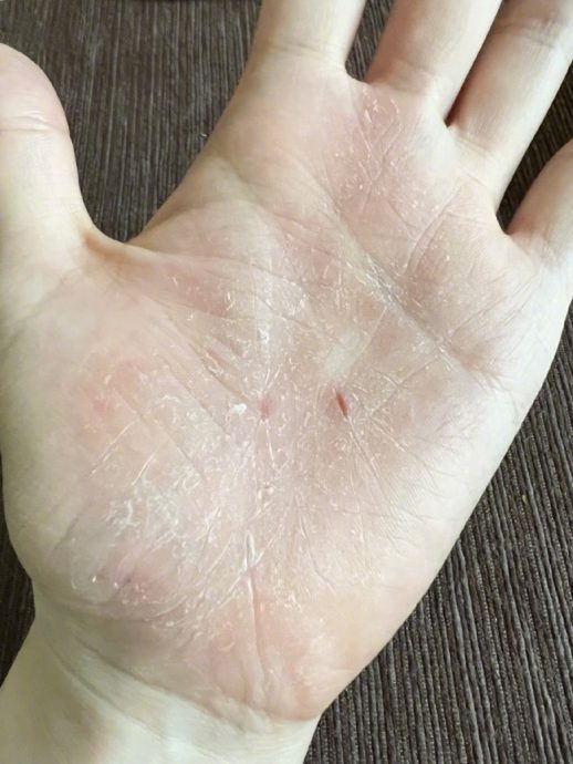 伸个懒腰手掌就流血 张靓颖：开始惜命