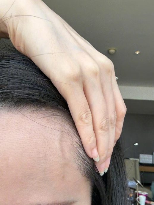 伸个懒腰手掌就流血 张靓颖：开始惜命