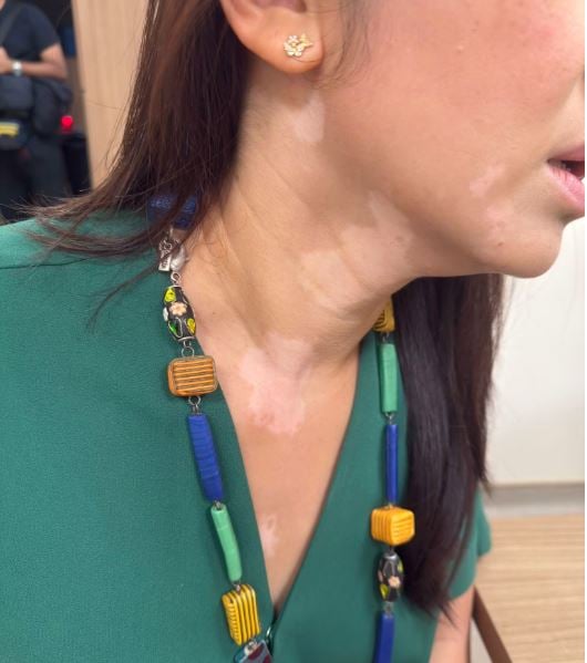 供星洲网:白癜风有特效药?狮城女患者为治病停哺乳