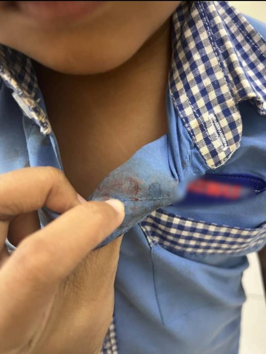 儿被4岁同学踢中鼻子流血 母震惊:我应该选择沉默吗?