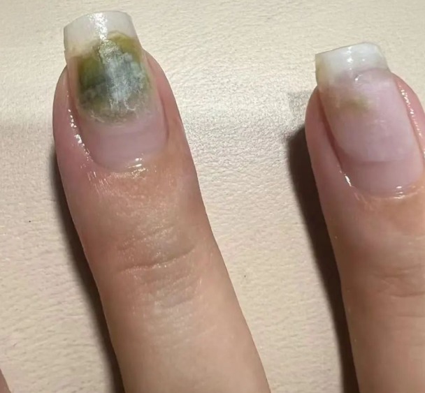 全国-求真｜美甲后4现象的真相/1图