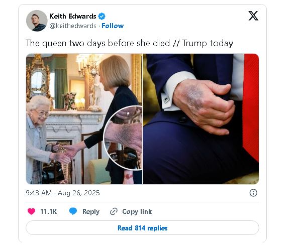 右手有瘀青 网上疯传特朗普与英女王过世前照片惊人相似