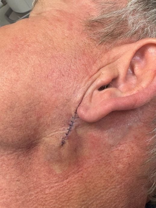 地狱厨神罹患皮肤癌 晒术后疤痕照获晓治积曼打气