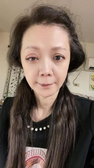 女星点错药水 右眼被灼伤险失明