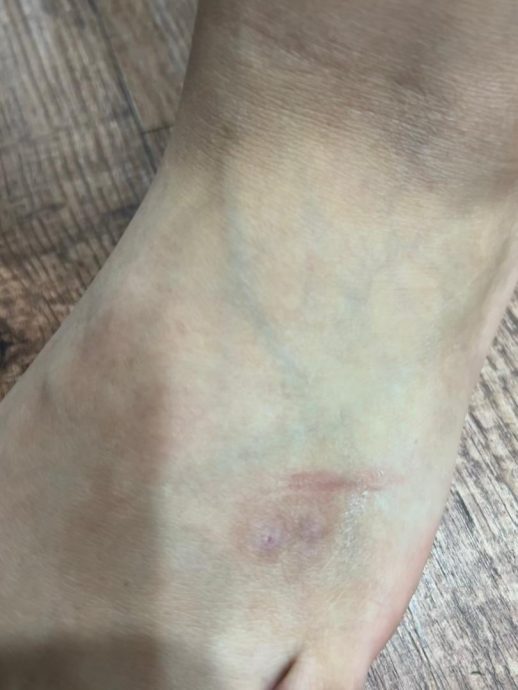 宠物狗抓伤脚板 舞蹈老师不认账 女子自费RM520打预防针报警