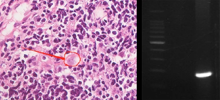 拚图两图) 6岁男童疑打水仗后感染食脑虫去世