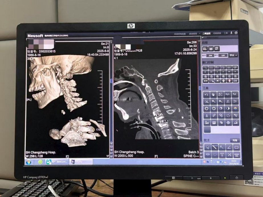 拼盘  全球罕见！上海医生救回“身首离断”患者　手术难度堪比登天
